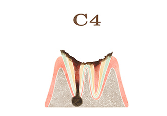 ​​(C4)　最重度のむし歯治療